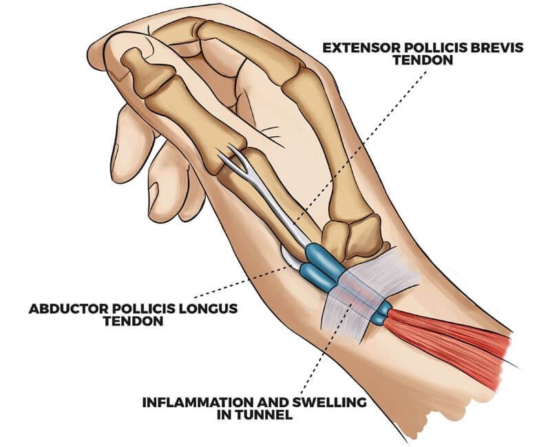 De Quervain s Tenosynovitis Wrap At Scott Mcrae Blog